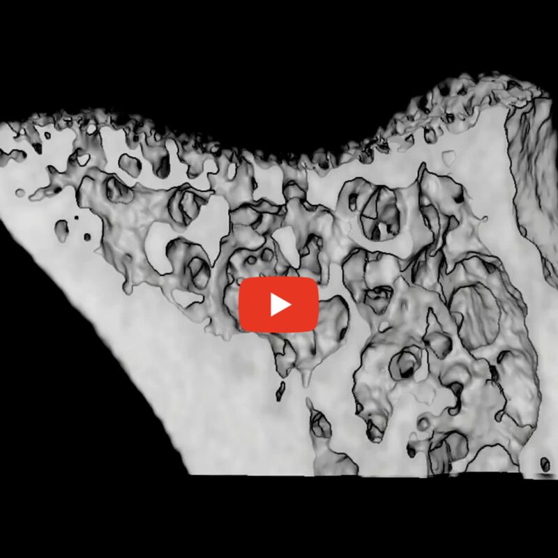 Early bone osteolytic lesion in mouse tibia at day 27 visualized with in vivo microCT